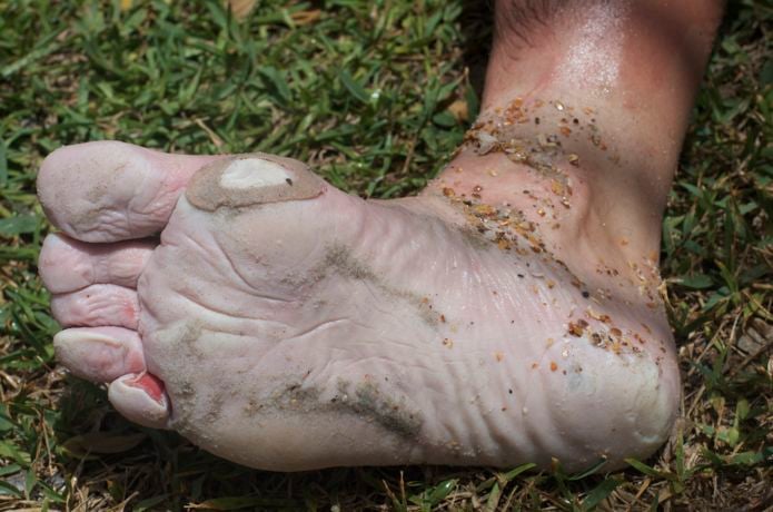 Close-up of a dirty, blistered foot on grass, highlighting rucking injury prevention for GORUCK gear.
